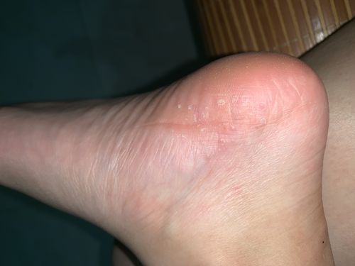 脚上小水泡 好痒 是湿疹吗?