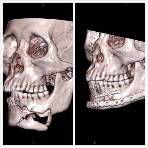 界首市人民医院口腔科成功开展首例下颌骨粉碎性骨折切开复位内固定