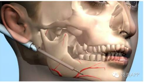 下颌骨削骨手术全过程3D 下颌骨削骨手术视频