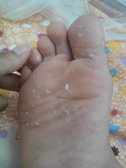 走路多或者天一热脚就特别痒起很多个密密麻麻的水泡水泡很痒全年